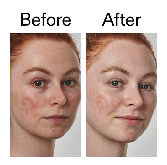 The INKEY List Supersolutions 10% Azelaic Acid Serum – Redness Relief
